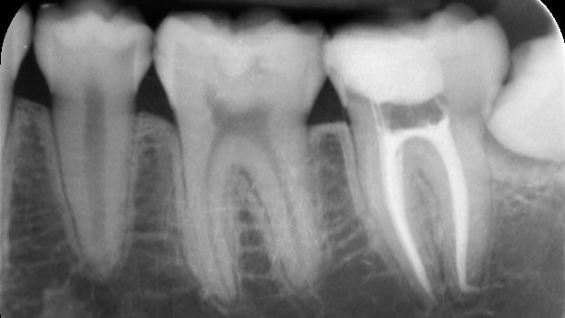 Endodonzia | Studio Odontoiatrico Dr. Colombo Bolla - Dr. Brivio
