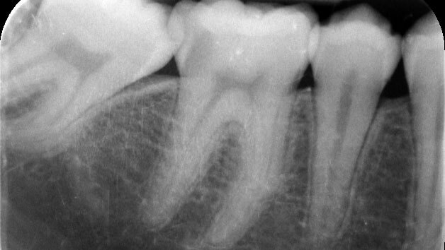 Endodonzia | Studio Odontoiatrico Dr. Colombo Bolla - Dr. Brivio