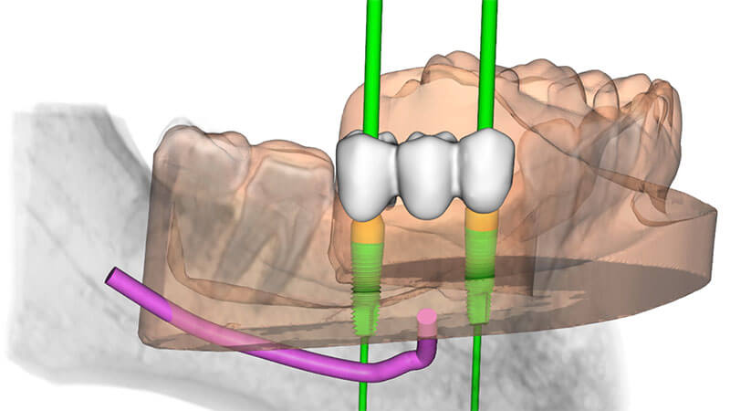 Implantologia Mini-invasiva | Studio Odontoiatrico Dr. Colombo Bolla - Dr. Brivio