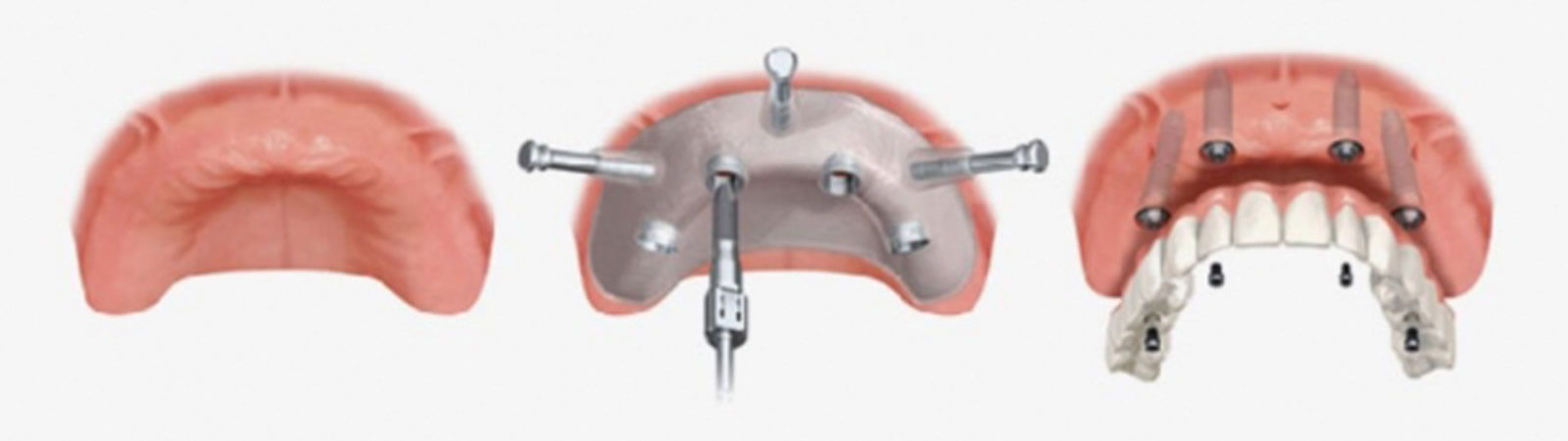 Implantologia Mini-invasiva | Studio Odontoiatrico Dr. Colombo Bolla - Dr. Brivio