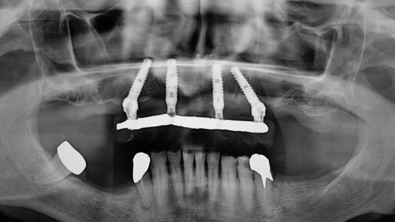 Implantologia | Studio Odontoiatrico Dr. Colombo Bolla - Dr. Brivio