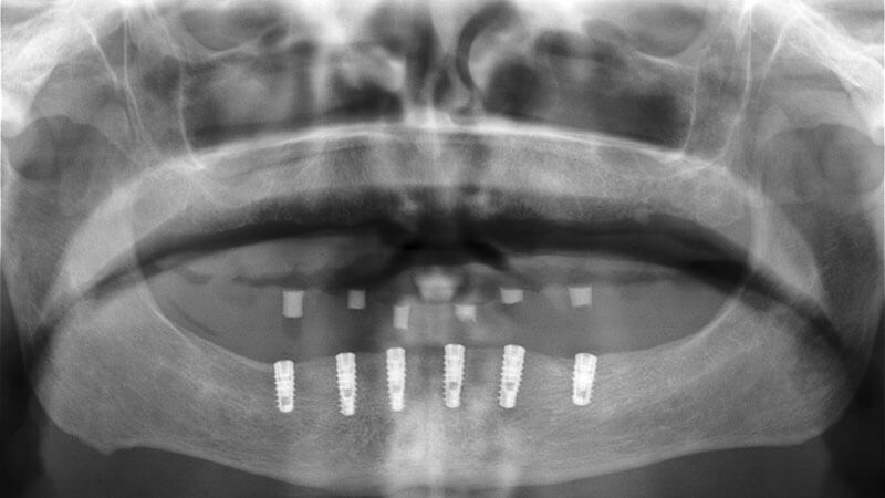 Implantologia | Studio Odontoiatrico Dr. Colombo Bolla - Dr. Brivio