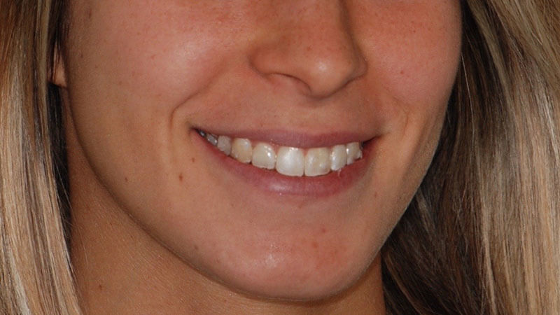 Ortodonzia Invisibile | Studio Odontoiatrico Dr. Colombo Bolla - Dr. Brivio