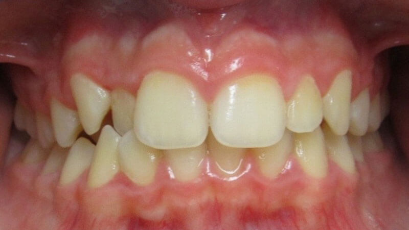 Ortodonzia Invisibile | Studio Odontoiatrico Dr. Colombo Bolla - Dr. Brivio