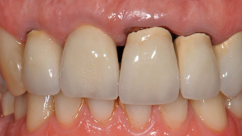 Parodontologia | Studio Odontoiatrico Dr. Colombo Bolla - Dr. Brivio